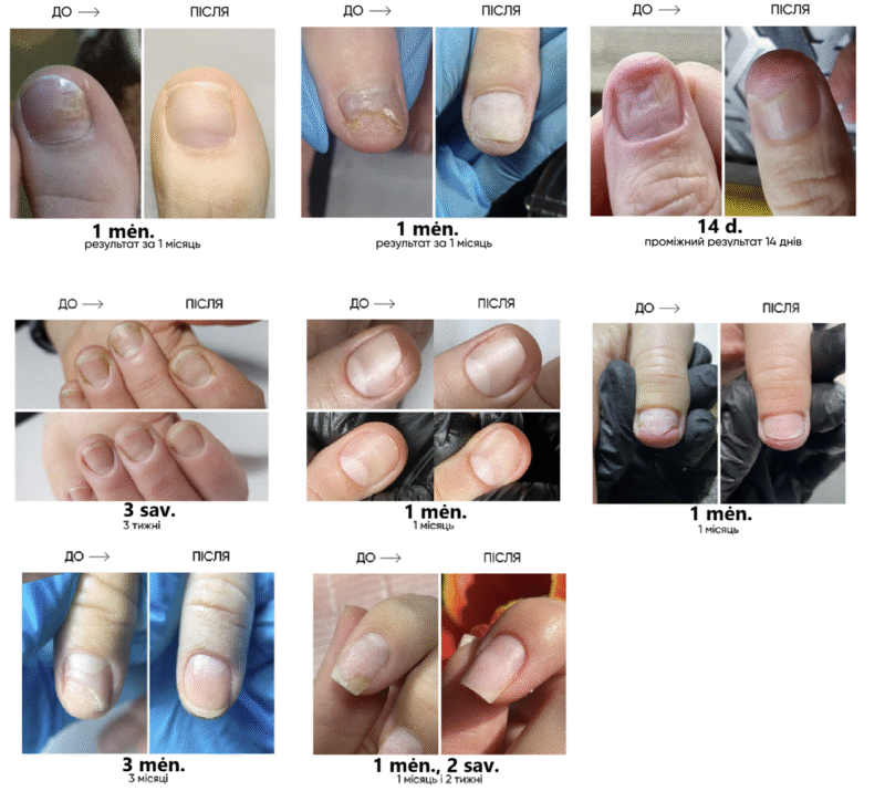 Komilfo Nail Fix arbatmedžio nagų eliksyras nuo onicholizės, 10 ml - Image 3