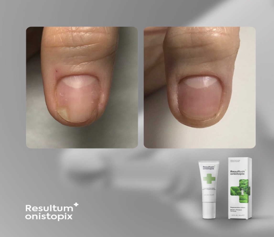 Resultum Onistopix lpsjonas nuo onicholizės ir grybelio 10 ml - Image 2