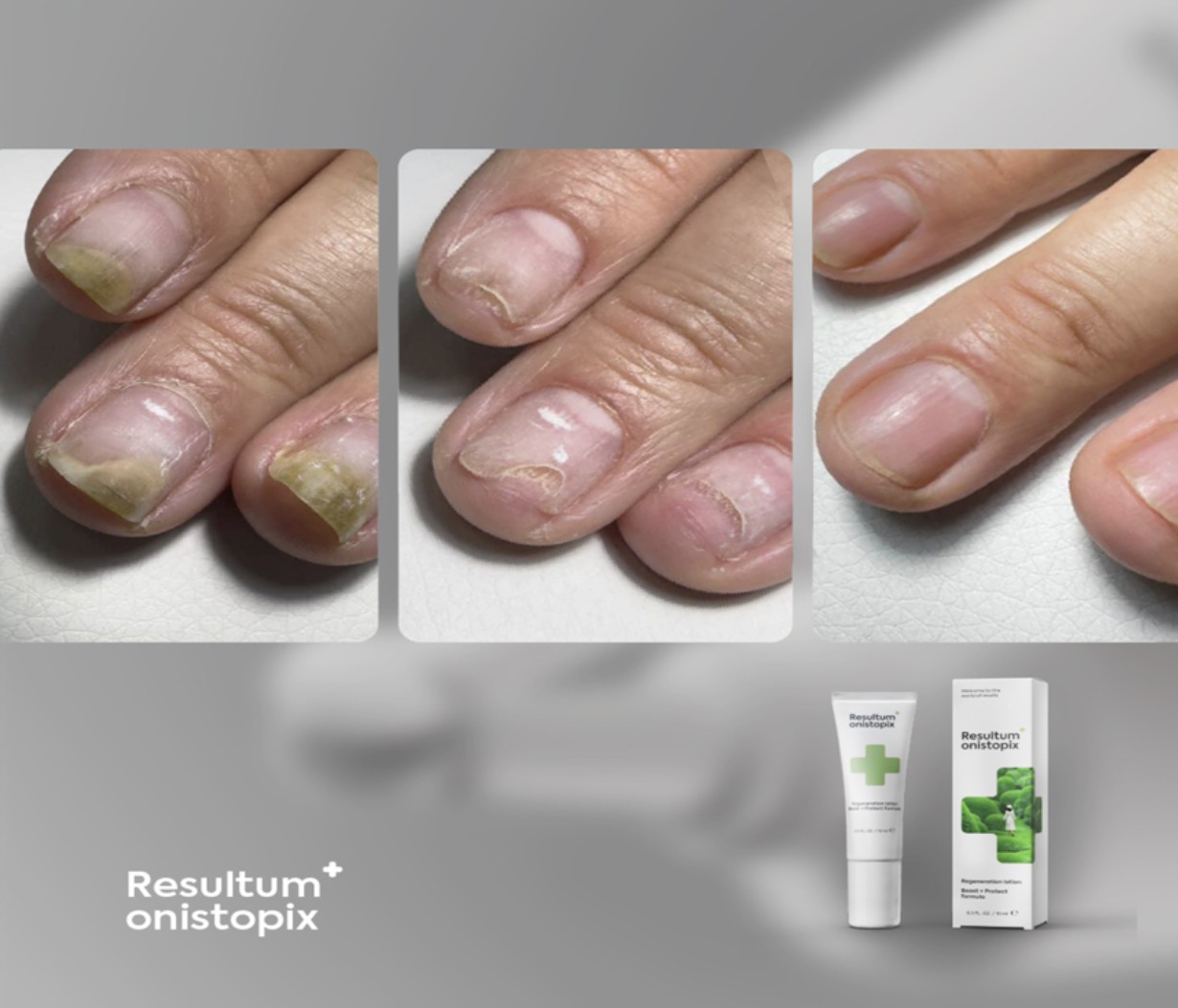 Resultum Onistopix lpsjonas nuo onicholizės ir grybelio 10 ml - Image 3